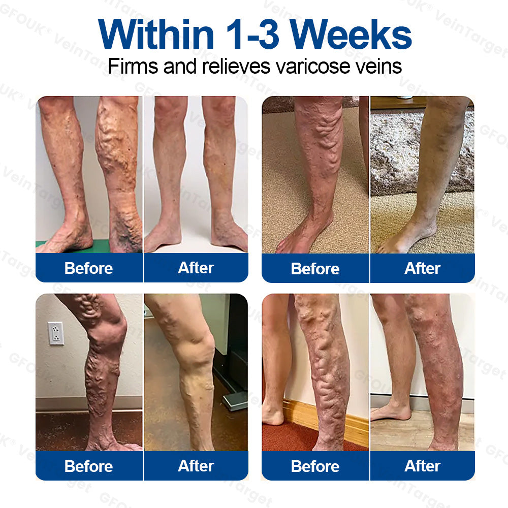 🇺🇸👨‍⚕️👍✅GFOUK® VeinTarget Microneedle Patch⚡Instant Relief, Long-Term Results